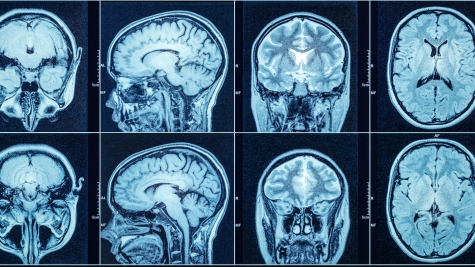 Closeup of a CT scan with brain