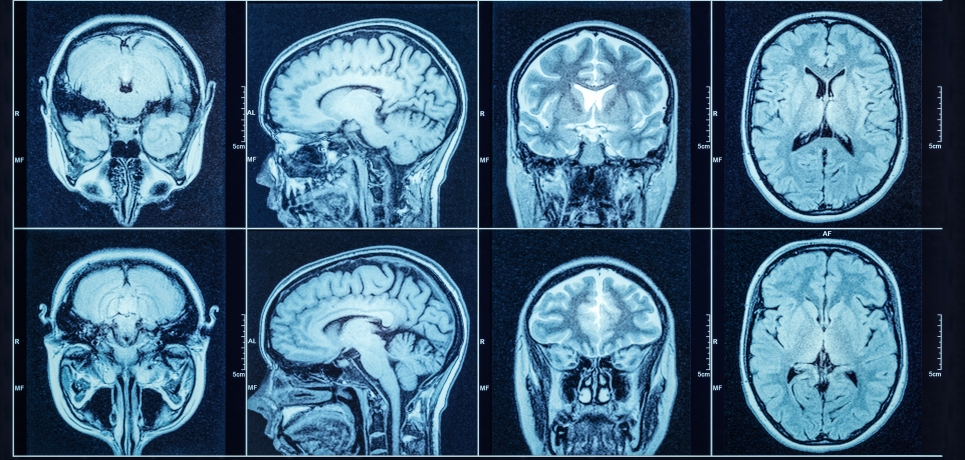 Closeup of a CT scan with brain