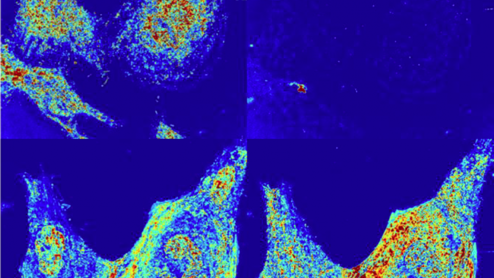 Alterations of the nanoscale structure of live HeLa cells after chemical fixation, as observed using partial wave spectroscopic (PWS) optical microscopy.  Chemical fixation appears to alter the cellular nanoscale structure in addition to terminating its macromolecular remodeling.  These changes could not be detected using traditional modes of optical microscopy, being far smaller than the diffraction limit of visible light.